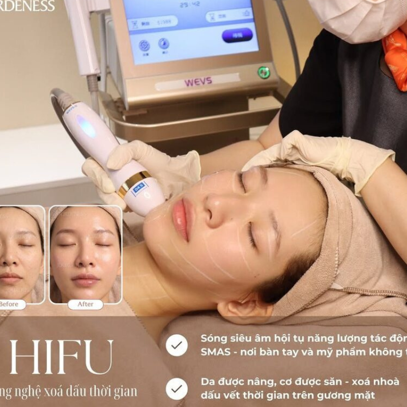 ✨HIFU NÂNG CƠ TOÀN MẶT 60 PHÚT✨