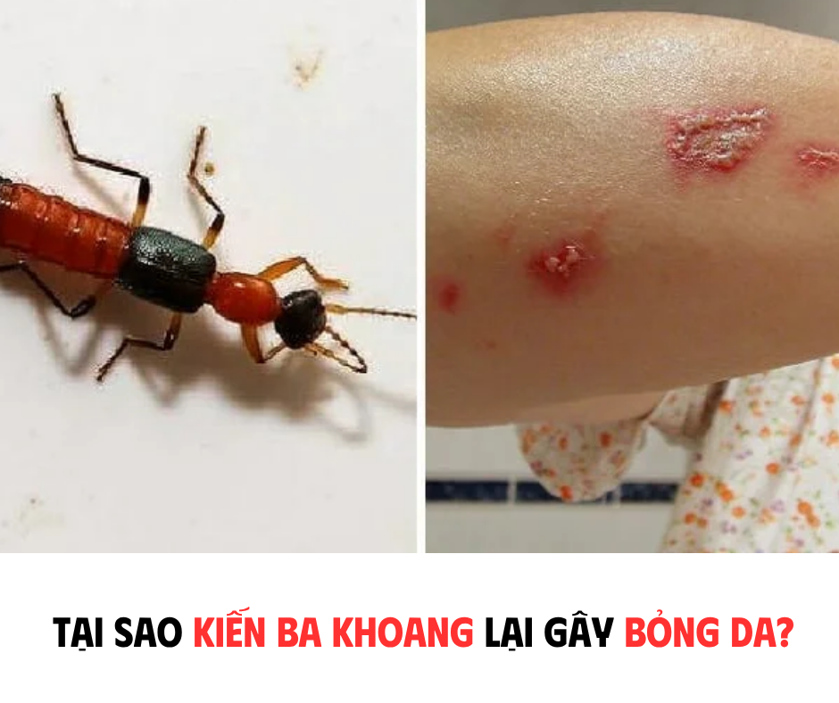 TẠI SAO KIẾN BA KHOANG LẠI GÂY BỎNG DA?