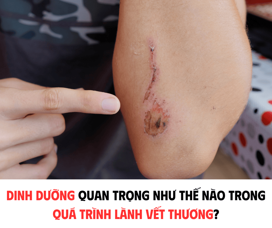 DINH DƯỠNG QUAN TRỌNG NHƯ THẾ NÀO TRONG QUÁ TRÌNH LÀNH VẾT THƯƠNG ?
