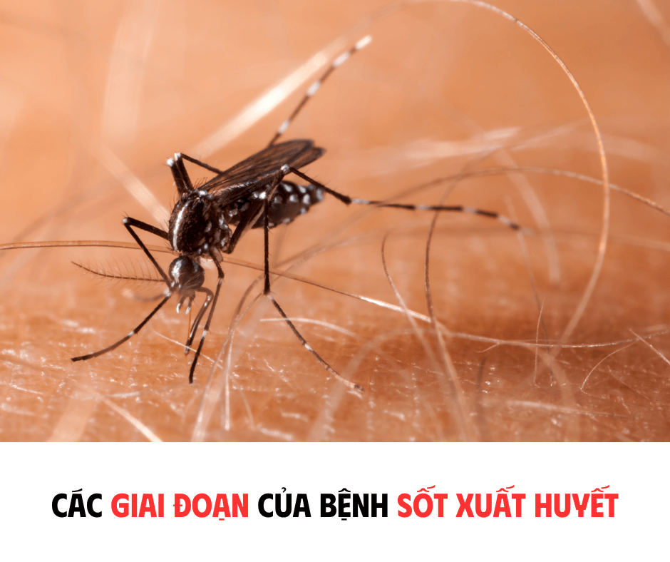 CÁC GIAI ĐOẠN CỦA BỆNH SỐT XUẤT HUYẾT