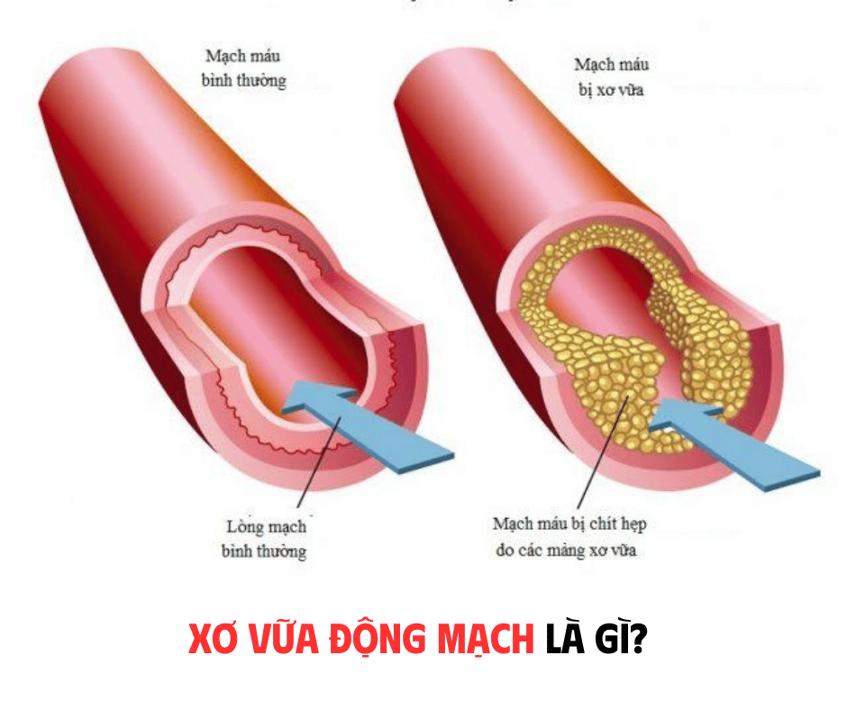 XƠ VỮA ĐỘNG MẠCH LÀ GÌ? CƠ CHẾ HÌNH THÀNH XƠ VỮA ĐỘNG MẠCH