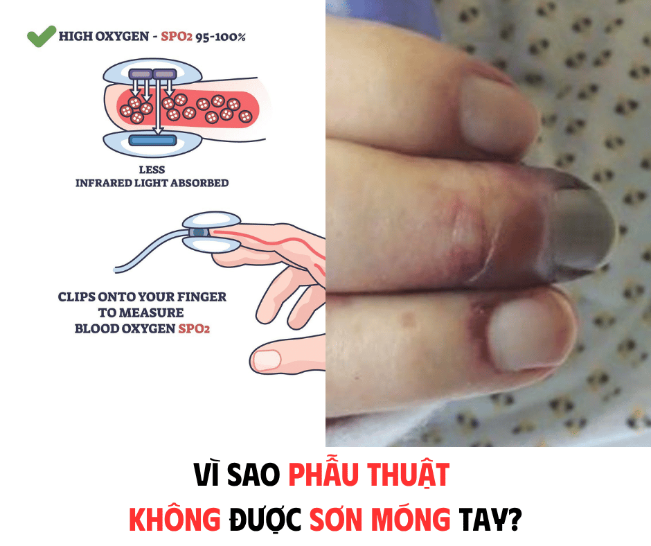 VÌ SAO PHẪU THUẬT KHÔNG ĐƯỢC SƠN MÓNG TAY?