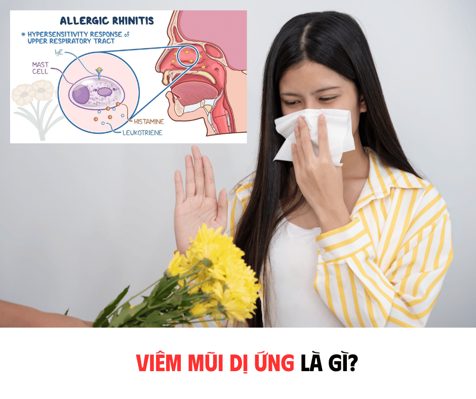 VIÊM MŨI DỊ ỨNG LÀ GÌ?