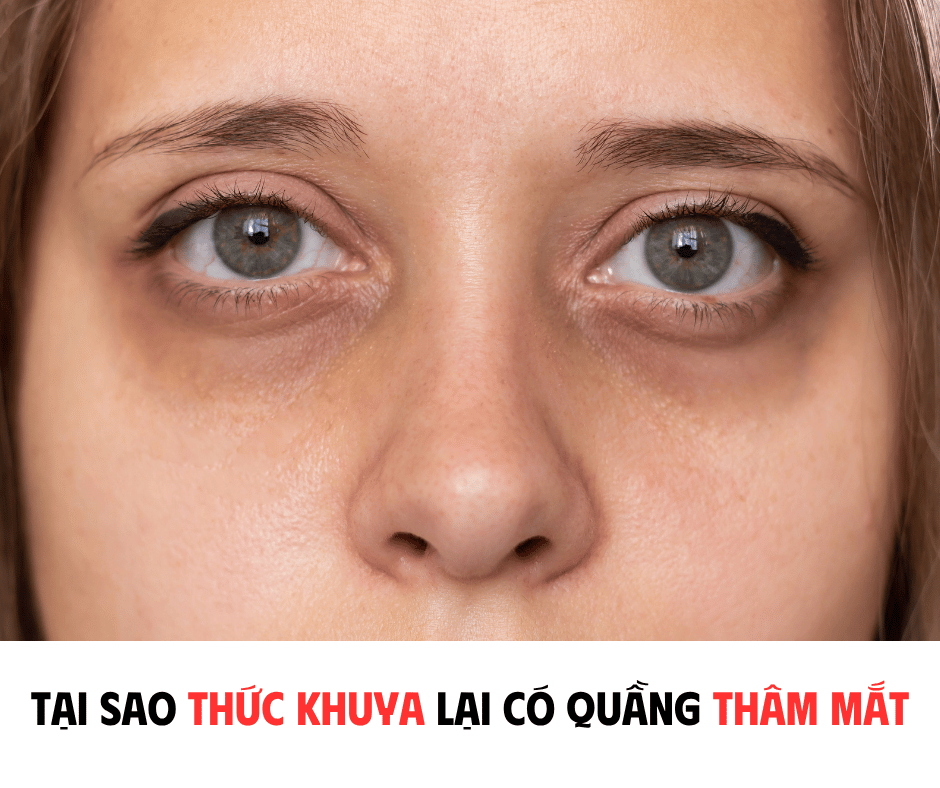 TẠI SAO THỨC KHUYA LẠI CÓ QUẦNG THÂM MẮT