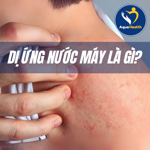 Dị ứng nước máy là gì