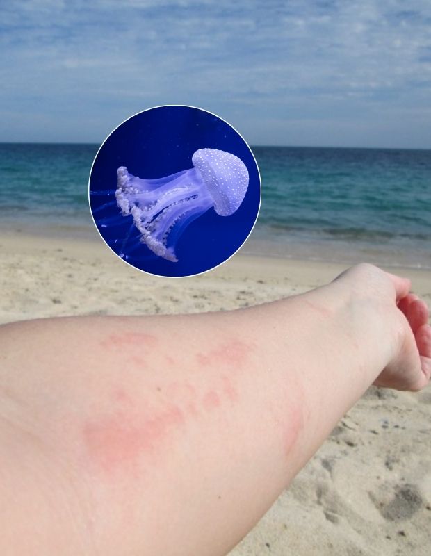 Bị sứa biển cắn phải làm sao? Cách xử lý khi bị sứa cắn