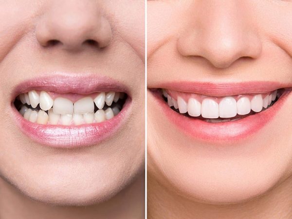 Tại sao phải bọc răng sứ?