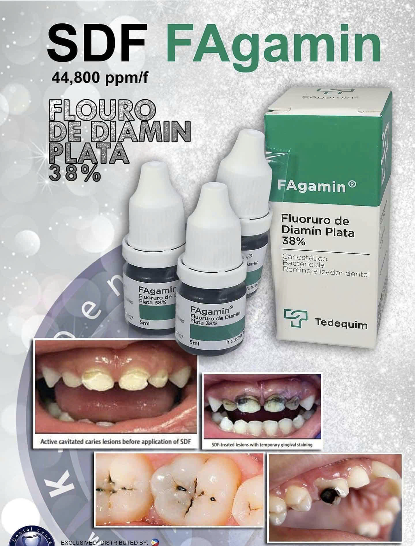 SDF nha khoa – Giải pháp hiện đại ngăn ngừa sâu răng không cần khoan trám