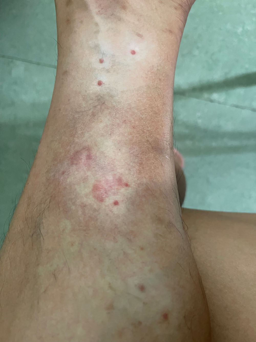 Đôi chân bất trị của tôi bị nước bẩn đùng tôm ăn hại