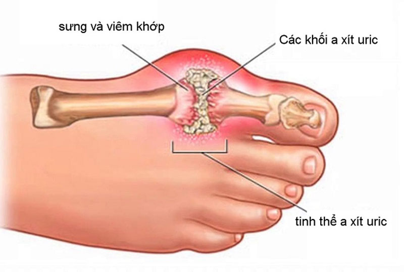 Gout là gì? Nguyên nhân, triệu chứng và cách điều trị bệnh gout
