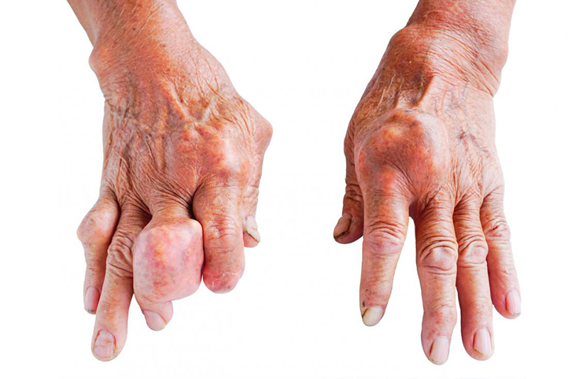 Bệnh gout biến chứng: Kẻ thù thầm lặng đang âm thầm tấn công cơ thể