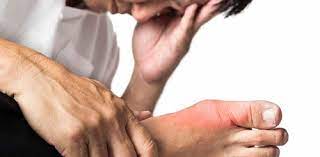 Bệnh Gout có mổ được không?