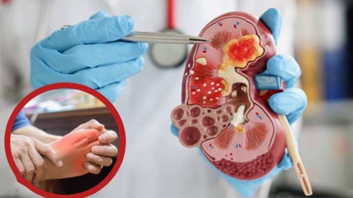 Bệnh gout do thận: Nguyên nhân, triệu chứng, điều trị và phòng ngừa