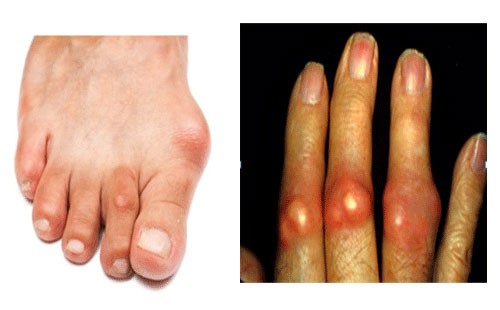 Bệnh gout ở người trẻ: Nguyên nhân, triệu chứng, điều trị và cách phòng ngừa