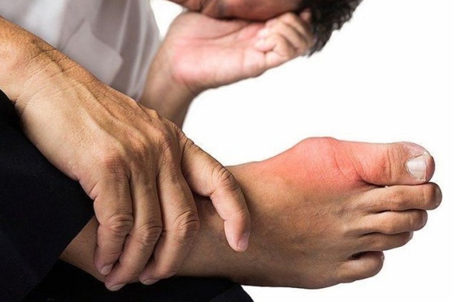 Bệnh gout và tiểu đường: Mối liên hệ, nguyên nhân, triệu chứng và cách phòng ngừa