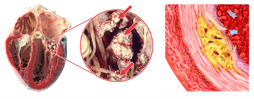 Bệnh gout và bệnh tim: Mối liên hệ, biến chứng và cách phòng ngừa