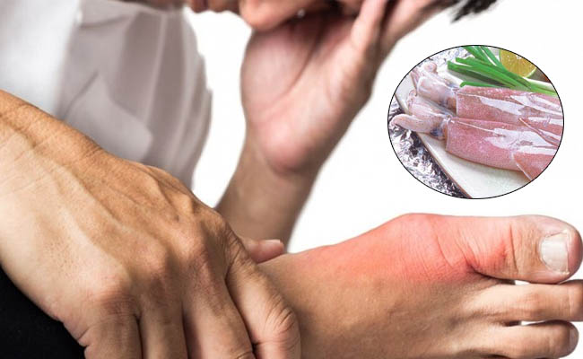 Bệnh gout ăn mực được không