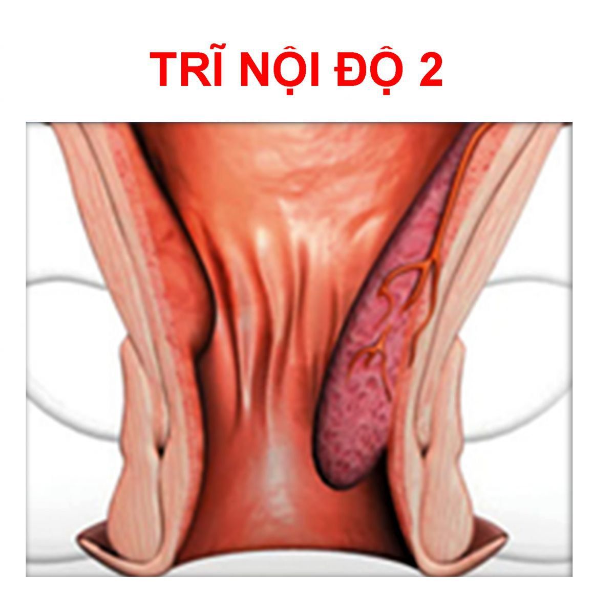 Bệnh Trĩ Độ 2: Nguyên Nhân, Triệu Chứng và Cách Điều Trị