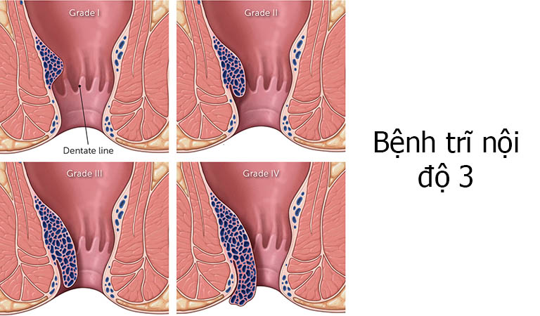 Bệnh trĩ độ 3: Nguyên nhân, triệu chứng, chẩn đoán, điều trị và phòng ngừa