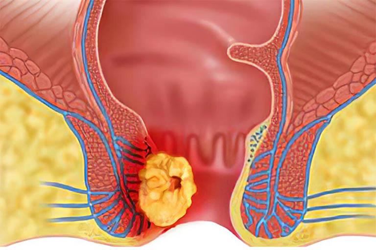 Bệnh Trĩ Độ 4: Nguyên Nhân, Triệu Chứng, Điều Trị và Cách Phòng Ngừa