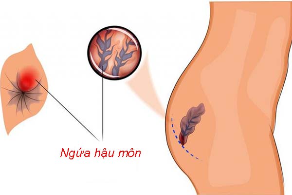 Bệnh Trĩ Gây Ngứa Hậu Môn: Nguyên Nhân, Triệu Chứng và Cách Điều Trị