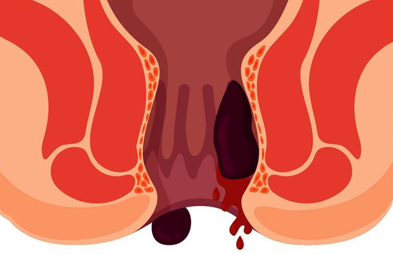 Bệnh Trĩ Gây Thiếu Máu: Nguyên Nhân, Triệu Chứng và Cách Điều Trị