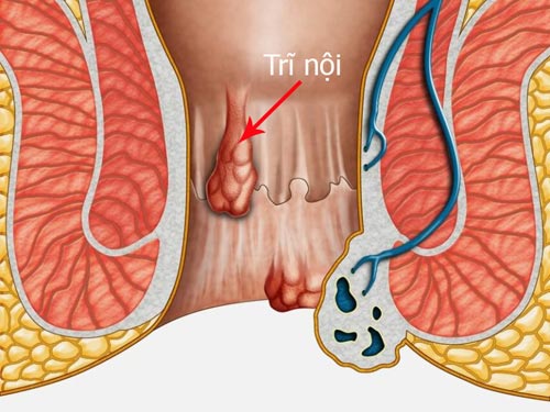 Biểu hiện của bệnh trĩ nội: Dấu hiệu nhận biết, nguyên nhân và cách điều trị