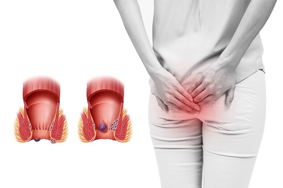 Dấu hiệu bệnh trĩ ở phụ nữ: Nhận biết sớm để điều trị hiệu quả