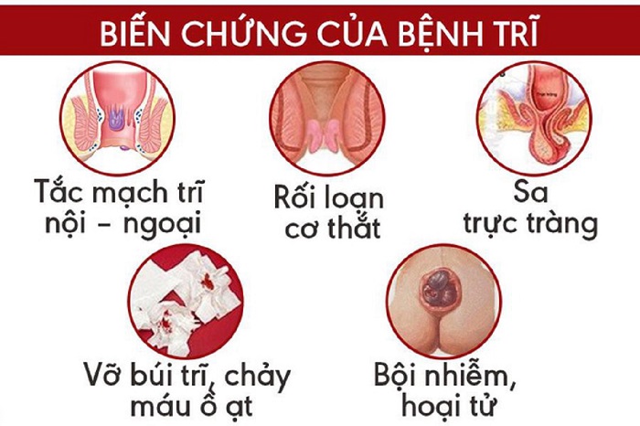 Hậu quả của bệnh trĩ: Những biến chứng nguy hiểm không thể xem nhẹ