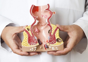 Dấu Hiệu Bệnh Trĩ Tái Phát: Nguyên Nhân, Triệu Chứng và Cách Phòng Ngừa