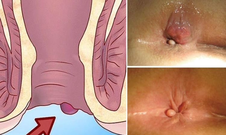 Cách chữa bệnh trĩ tại nhà: Phương pháp hiệu quả và an toàn