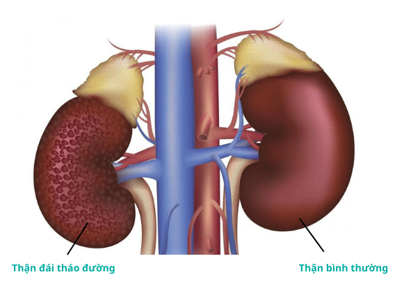 Đái tháo đường biến chứng suy thận: Nguyên nhân, dấu hiệu và cách phòng ngừa