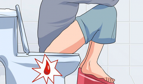 Bệnh trĩ chữa như thế nào: Tìm Hiểu Phương Pháp Điều Trị
