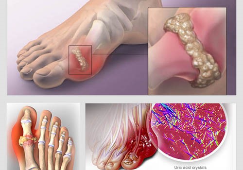 Dấu hiệu bệnh gout giai đoạn đầu: Nhận biết sớm để điều trị hiệu quả