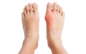 Dấu hiệu bệnh Gout cấp: Nguyên nhân, triệu chứng, chẩn đoán và điều trị