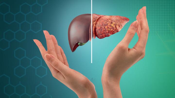 Gan Nhiễm Mỡ Biểu Hiện Như Thế Nào? Triệu Chứng, Nguyên Nhân và Cách Phòng Ngừa