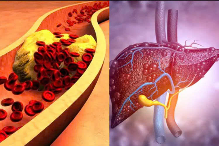 Gan nhiễm mỡ và máu nhiễm mỡ: Triệu chứng, biến chứng, mối liên hệ và cách phòng ngừa
