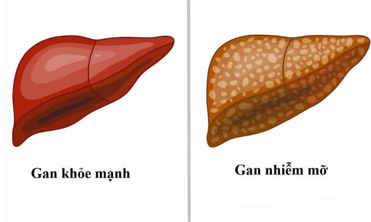 Gan nhiễm mỡ: Nguyên nhân, triệu chứng và cách phòng ngừa hiệu quả