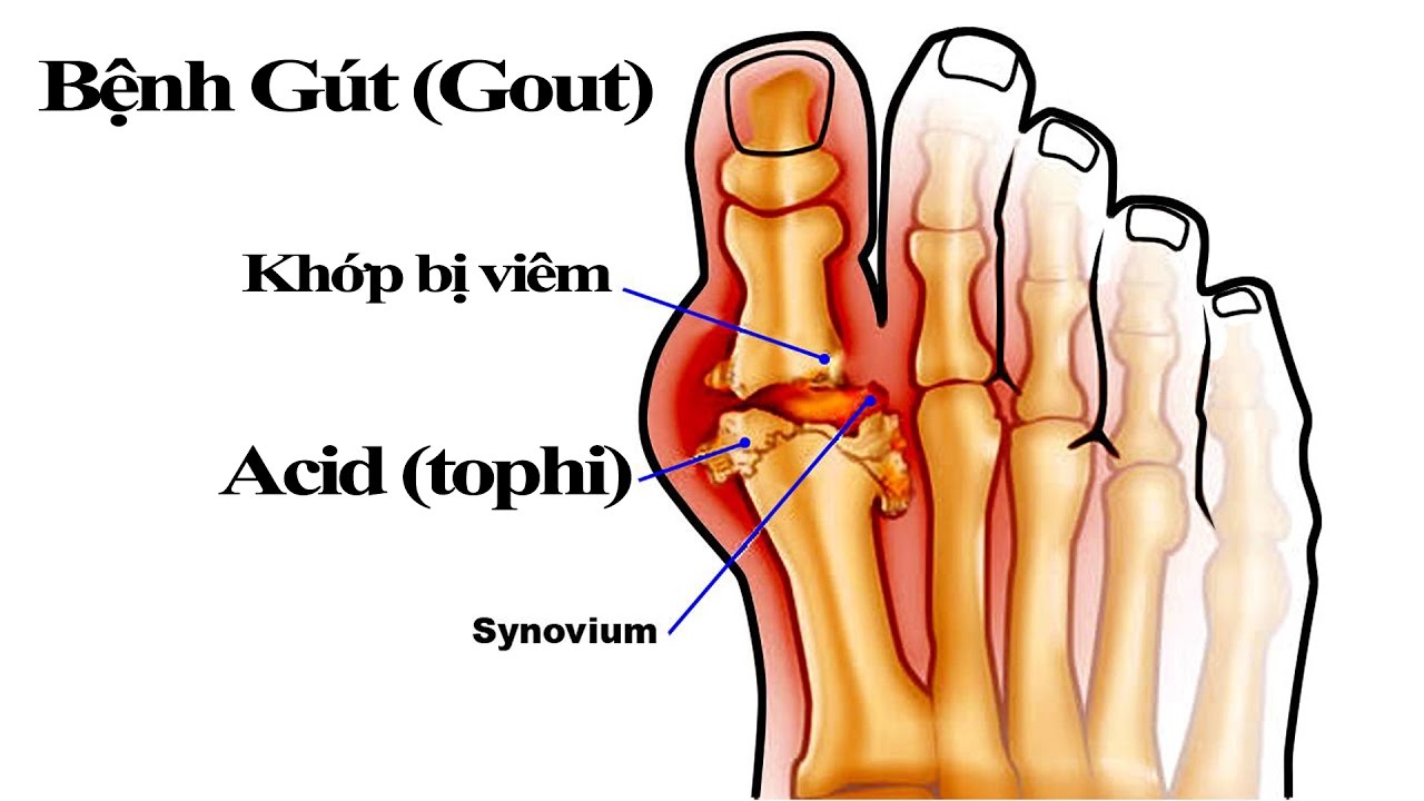 Hạt tophi trong bệnh Gout: Nguyên nhân, triệu chứng, vị trí, chẩn đoán và điều trị
