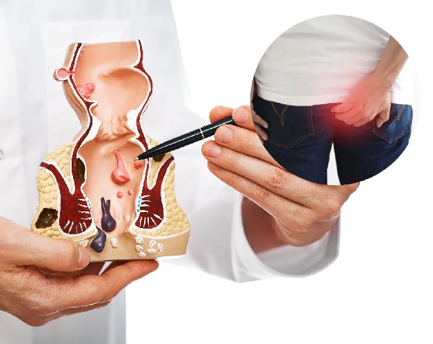 Bệnh Trĩ Khám Khoa Nào? Hướng Dẫn Toàn Diện Từ A Đến Z