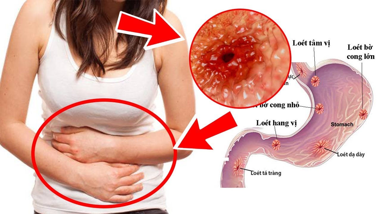 Loét dạ dày có phải ung thư không