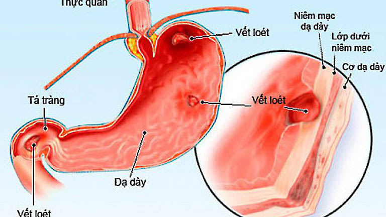 Loét dạ dày nặng có nguy hiểm không