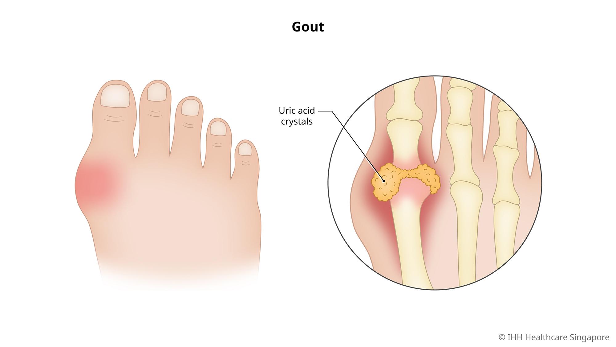 Lời khuyên cho người bệnh Gout