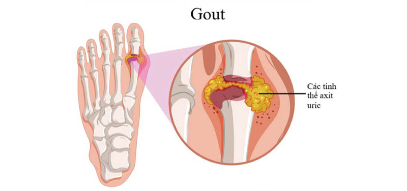Lý do tại sao bị gút