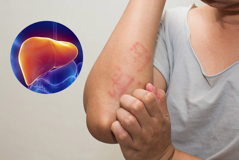 Mẩn Ngứa Do Suy Giảm Chức Năng Gan: Nguyên Nhân, Dấu Hiệu Và Cách Điều Trị
