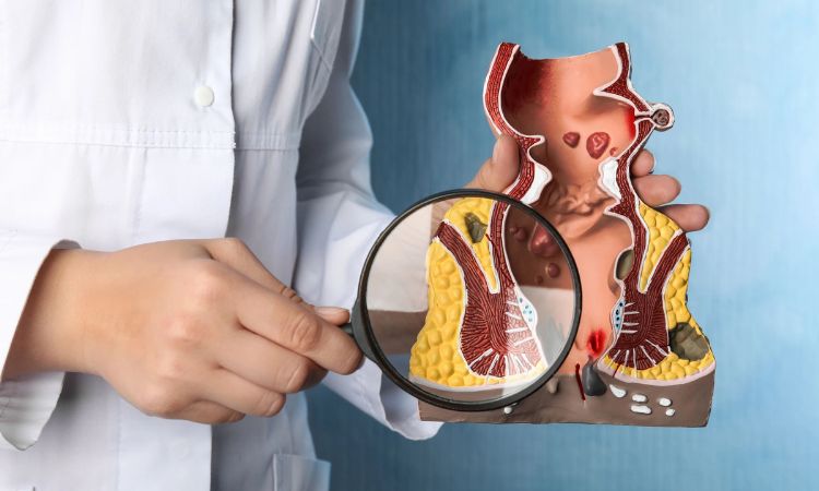 Nguyên nhân gây trĩ và cách phòng ngừa hiệu quả