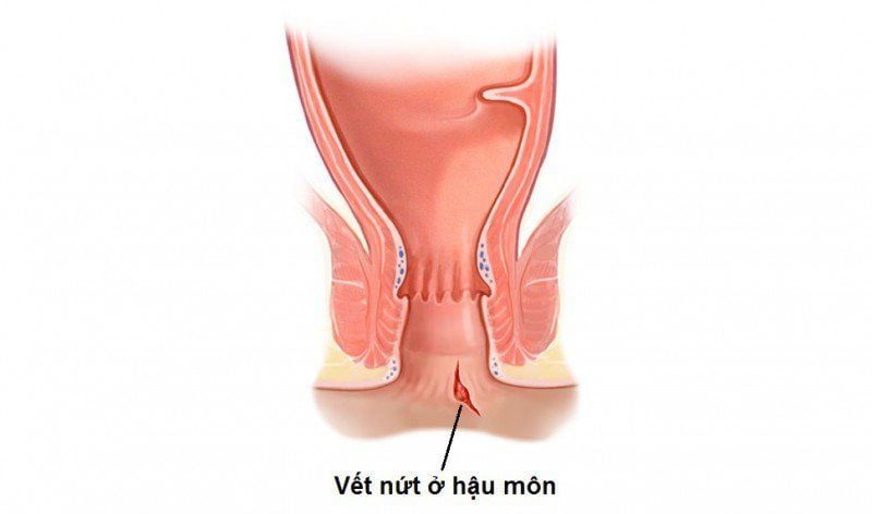 Phân Biệt Bệnh Trĩ và Nứt Kẽ Hậu Môn: Hiểu Đúng Để Điều Trị Hiệu Quả
