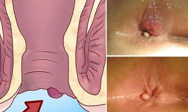 Bệnh trĩ có nguy hiểm không? Các biến chứng và phương pháp điều trị