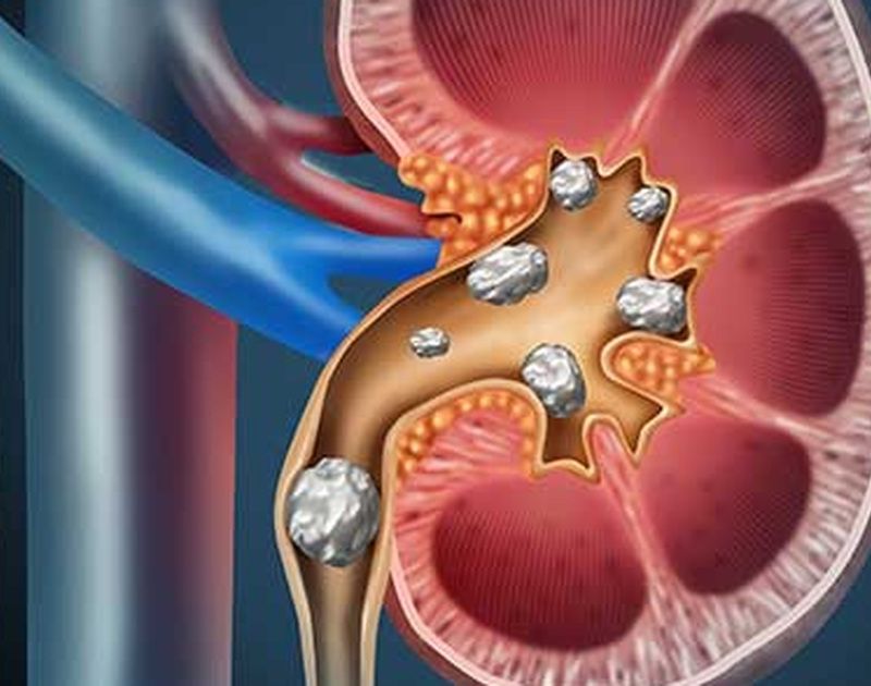 Sỏi thận: Nguyên nhân, triệu chứng, chẩn đoán và điều trị hiệu quả