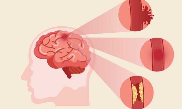 Tai biến mạch máu não là gì? Dấu hiệu, nguyên nhân và cách phòng ngừa hiệu quả